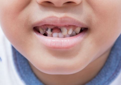 phòng và điều trị bệnh sâu răng ở trẻ